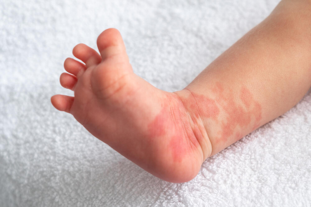 Hemangioma