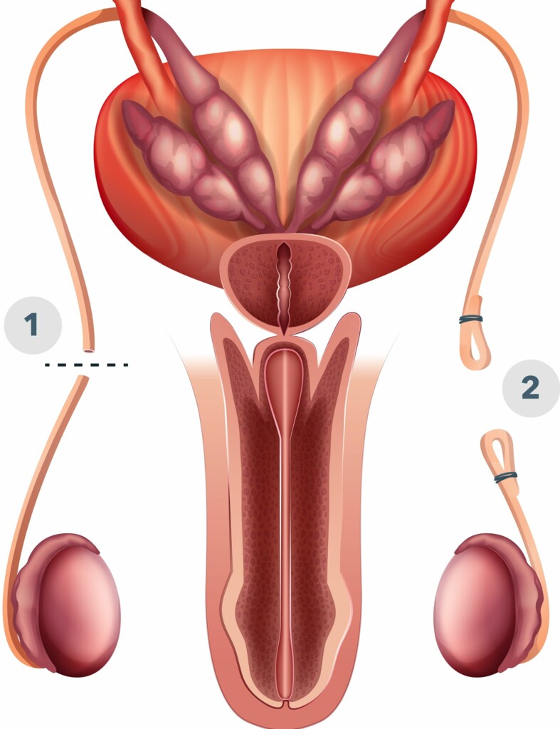 Vasectomy