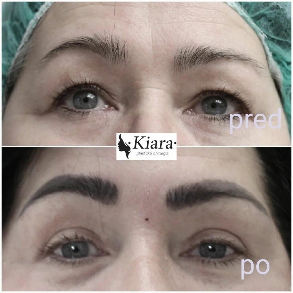 Upper lids