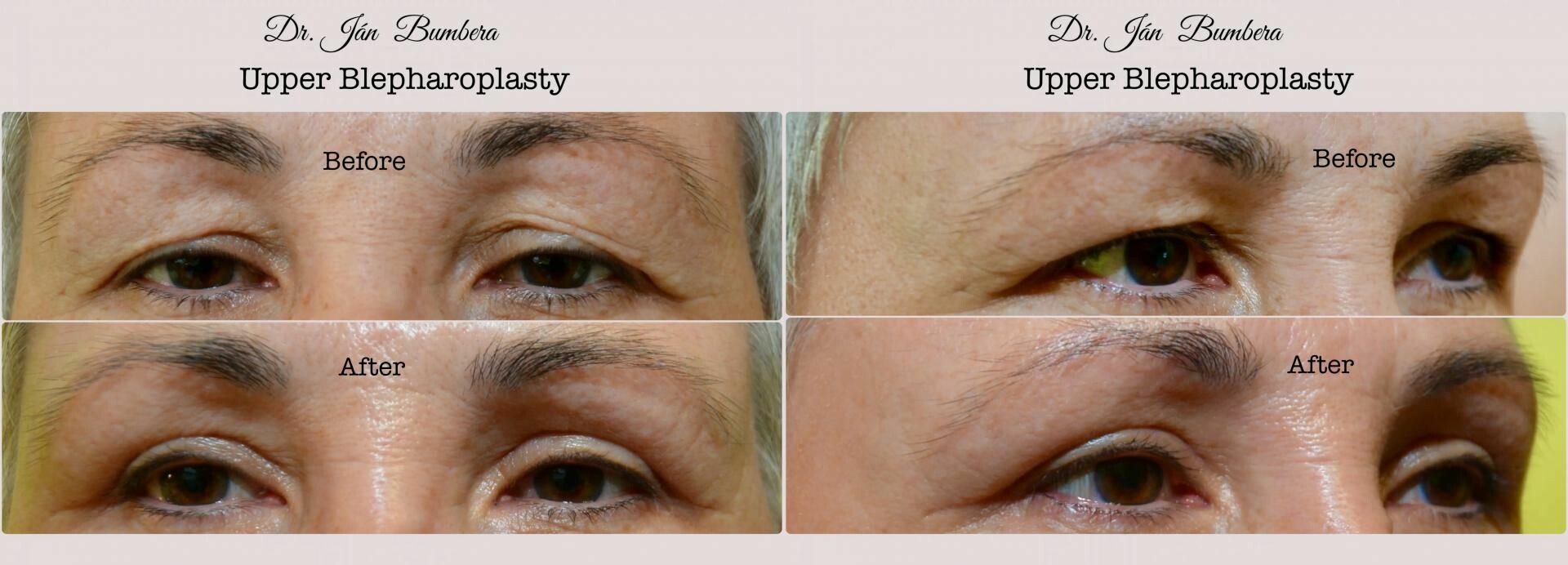 Upper Blepharoplasty
