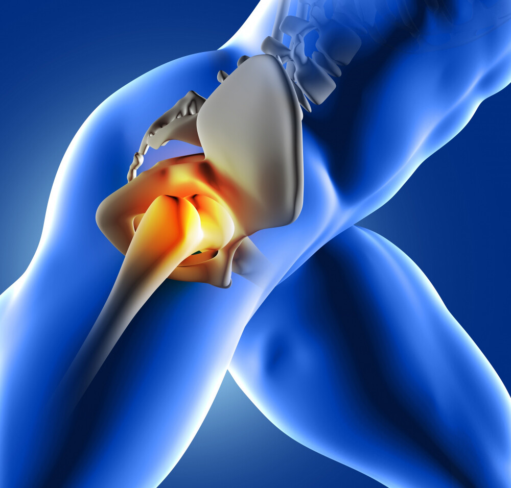 Hip replacement (Hip arthroplasty)